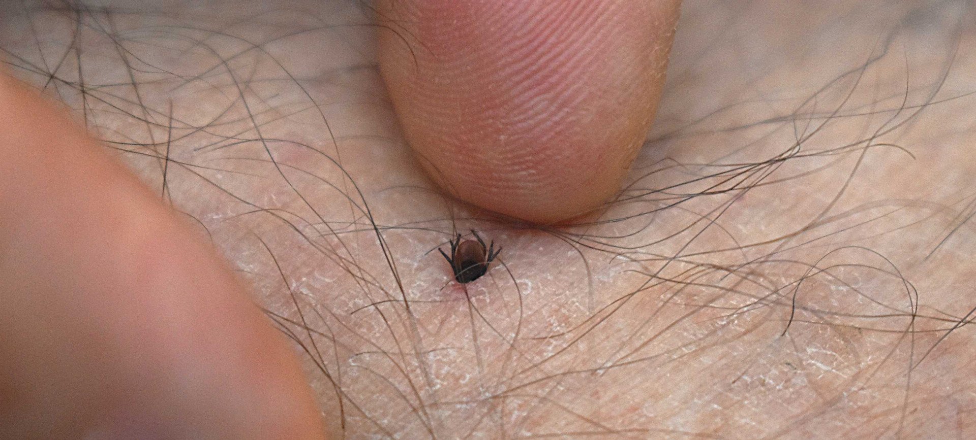 Výzva pacienta: nepodceňujte riziko encefalitidy, chraňte se očkováním!